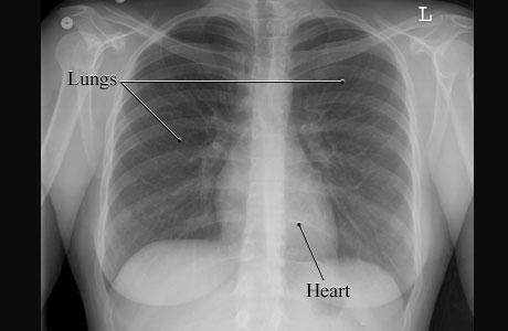 Chest X ray - St Vincent's Lung Health