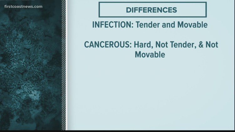 Difference between vaccine side effects, breast cancer symptoms - firstcoastnews.com