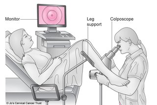 Colposcopy - What happens - NHS