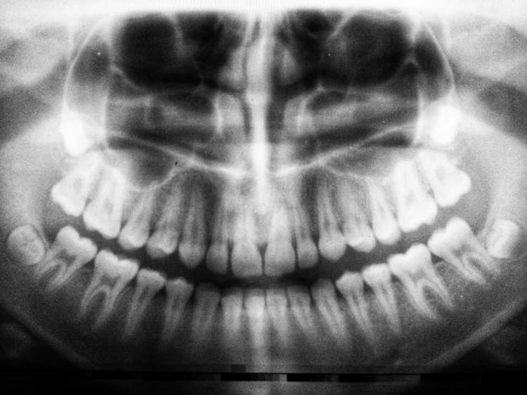 Are Dental X-Rays Safe? - Alluvial Dental Center