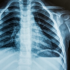 X-Rays: MedlinePlus
