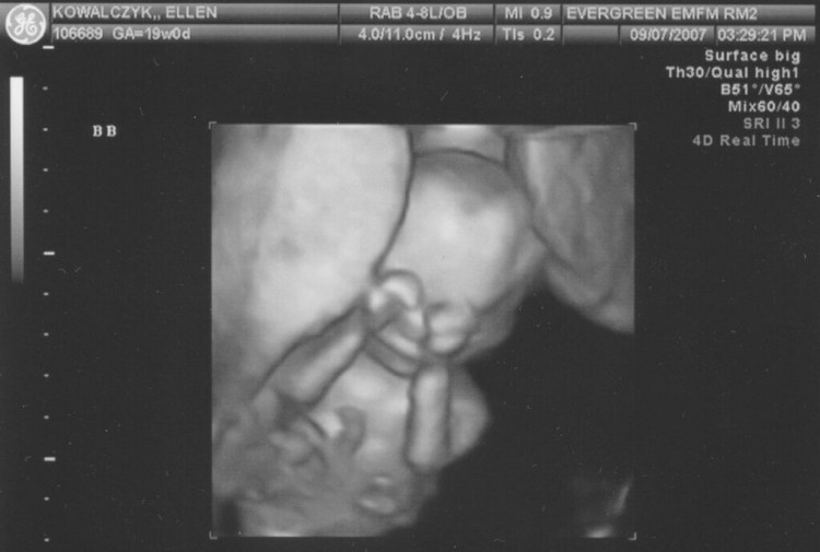 Emma Kowalczyk - 19 weeks - 3D ultrasound - She was a little… - Flickr