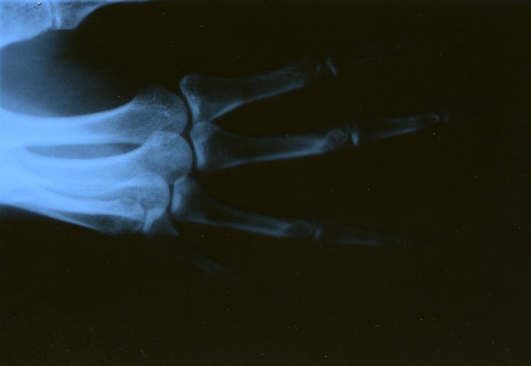 Right Hand X-Ray - Sprained my hand in late February. These … - Flickr