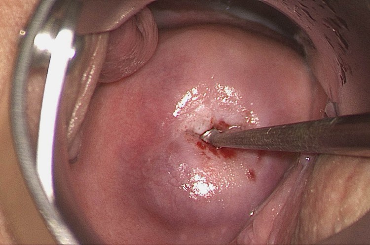 Secondary Prevention of Cervical Cancer