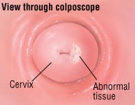 Patient Basics: Colposcopy - 2 Minute Medicine