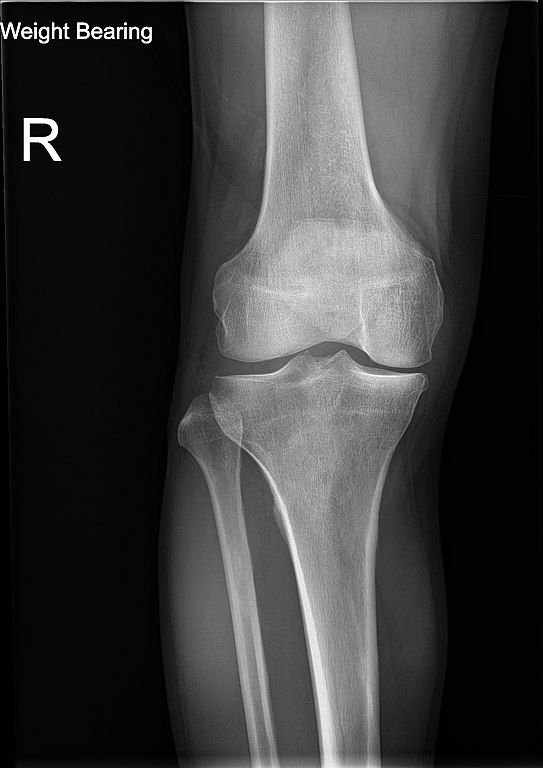 File:Knee plain X-ray weight bearing.jpg - Wikipedia
