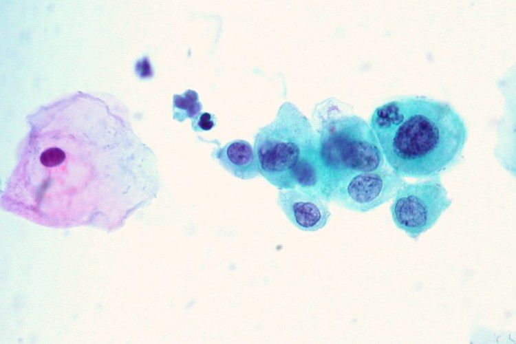 Cervical Correlation Case 2, ThinPrep Pap - 19-year-old woma… - Flickr