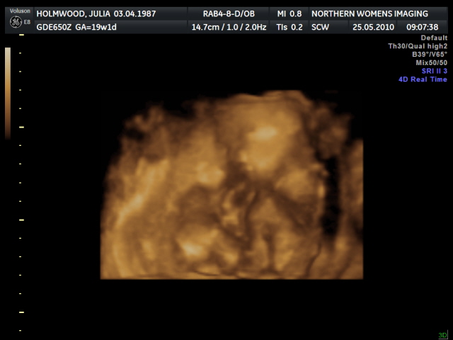 Ultrasound - 19 weeks - Julia - Flickr