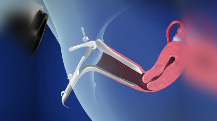 Colposcopy - Willis-Knighton Health System - Shreveport - Bossier City - Louisiana