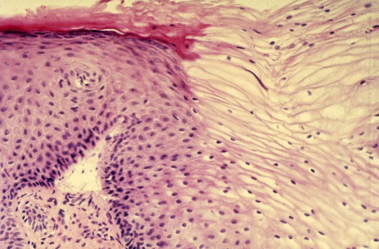 File:Diethylstilbestrol (des) cervix (29).jpg - Wikimedia Commons