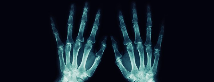 Hand x-ray