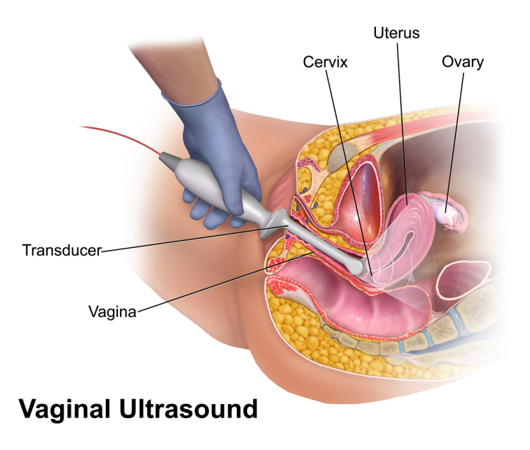 File:Vaginal Ultrasound.png - Wikimedia Commons