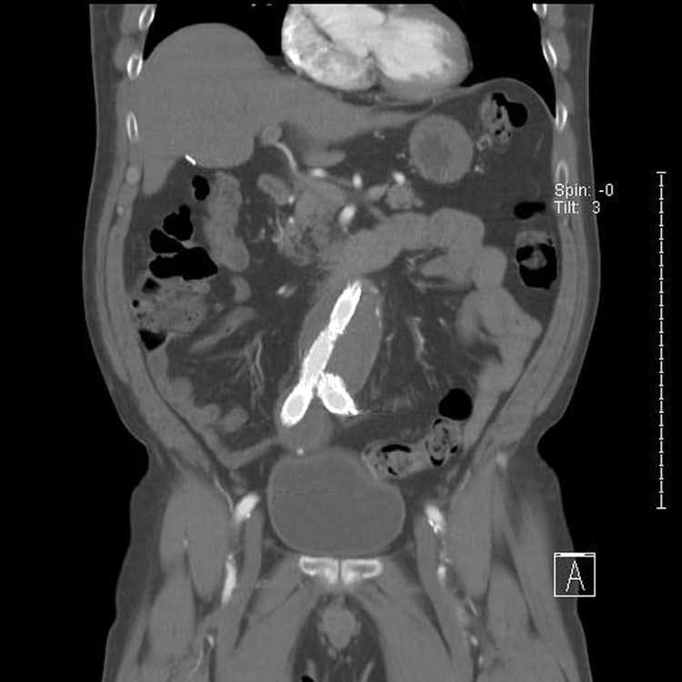 HD wallpaper: abdominal, aortic, aneurysm, stent, catscan, xray, medical - Wallpaper Flare