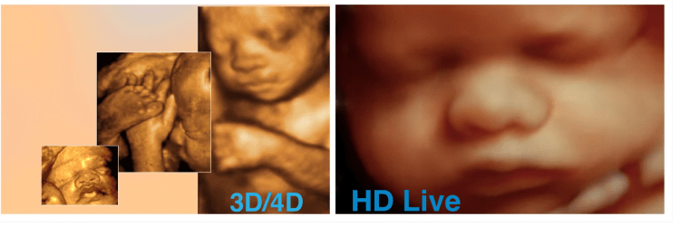 4D Ultrasound, 3D Ultrasound, 5D HD Live Ultrasound, Sonogram in Riverside